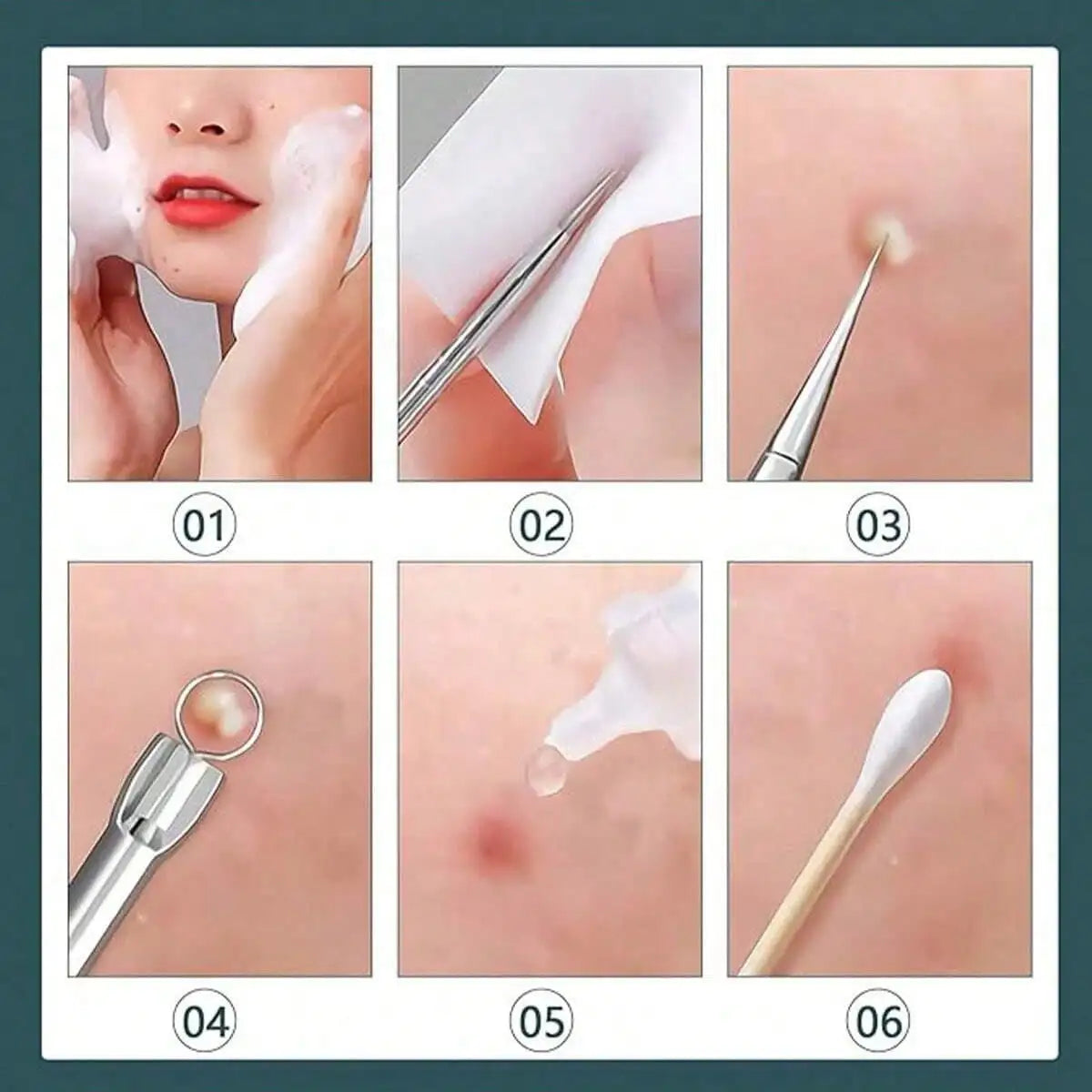 8pcs Acne, Blackhead, Dark Spot, Pimple Remover Tool Set, Skin Care Beauty, Pore Cleansing Kit